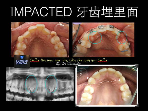 Braces Impacted Teeth