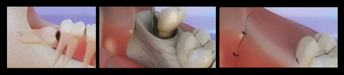 Wisdom tooth surgery-2