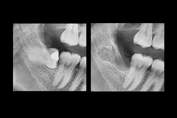 Wisdom tooth surgery-3